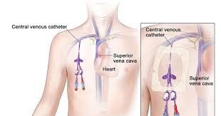 Electrolyte imbalances + central venous catheter stuff. Medicine The Central Venous Catheter Part 1