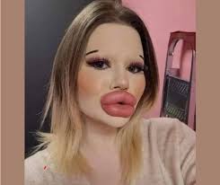Andrea Ivanova is known as the woman with the 'world's largest lips.'  Before vs After multiple surgeries: Which do you prefer?
