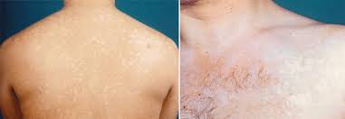 We did not find results for: Der Kleienpilzflechte Eine Kleben Medical Tribune