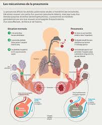 Une pneumopathie (ou pneumonie) signifie étymologiquement la maladie du poumon. Parfois Mortelle La Pneumonie Doit Etre Prise Tres Au Serieux Planete Sante