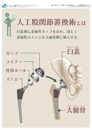 人工股関節置換術とは infographics 股関節 看護ノート 健康 イラスト