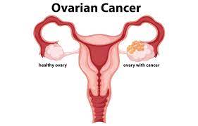 Common symptoms of ovarian cancer include bloating, pelvic pain, feeling full quickly, and urinary symptoms. Ovarian Cancer Causes Symptoms Risk Factor Treatment Fabwoman