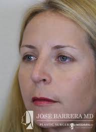 Top Rhinoplasty surgeon in San Antonio, TX