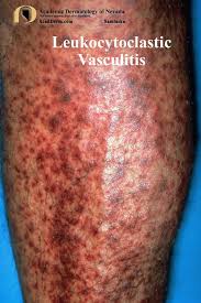 Image result for Vasculitis