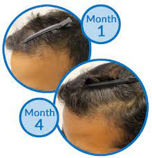 The condition varies slightly from male pattern baldness but can have a much greater impact because of less forgiving social norms regarding the appearance of women in public. A Receding Hairline And Dry Thinning Hair Developed In A Few Months