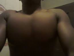 Whether they are on your shoulders, legs or buttocks, watch this video so th. Please Help Stretch Marks Wants To Finish My Shoulders Nairaland General Nigeria