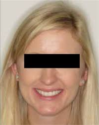 A predictable alternative to a smile in six months?