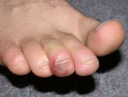 Image result for Chilblains