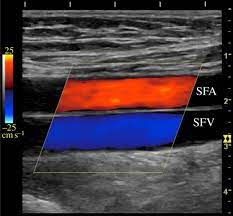 Alibaba.com offers 8,200 color doppler ultrasound price products. Ultrasonic Colour Doppler Imaging Interface Focus