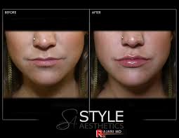 I just got some in my nasolabial folds and lips, and i can't wait to see how it really is going however, some simple tips to reduce the swellinginclude: Lip Filler I Portland Premiere Medspa I Juvederm Specials
