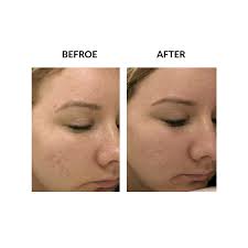 Coupled with platelet rich plasma (prp) skin rejuvenation therapy, the potential of your own body is used to improve the overall texture and tone of your skin, naturally. Micropen With Prp Skin Rejuvenation Therapy Mariposa Aesthetic Laser Center Oklahoma City Ok