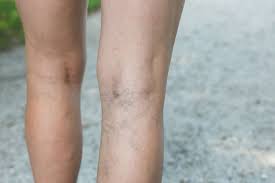 Trouvez la meilleure solution ! Varices Causes Prevention Et Traitements Pour Les Faire Disparaitre