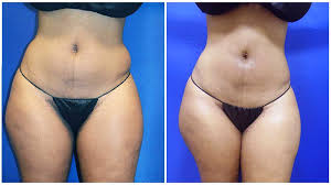 Maybe you would like to learn more about one of these? Hip Liposuction Chicago Chicago Liposuction By Lift Body Center