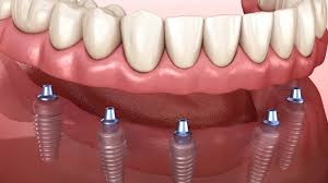 Dental Implants