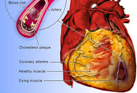 Getty heart attack symptoms can be difficult to spot for sure, because they can vary from person to person. Congestive Heart Failure Treatment Symptoms Stages Prevention Survival Rate