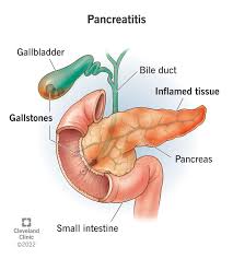 Pancreatitis treatment
