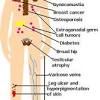 Mirror syndrome or triple edema or ballantyne syndrome is a rare disorder affecting pregnant women. 1
