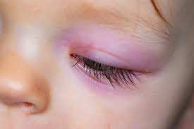 Studies of maculopapular rash in infectious mononucleosis. 14 Symptoms Of Epstein Barr Virus Page 12 Of 15