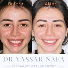 What an incredible smile 😁😍 —achieved without the need for fixed braces!  Clear aligners, like Eon Aligners and Invisalign, offer an excellent  alternative, helping you achieve the smile of your dreams. #eonaligners #