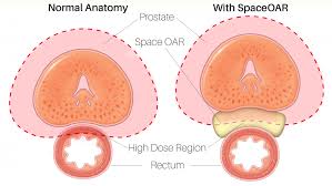 Although screenings for prostate cancer are one tool for early detecti. Spaceoar Hydrogel Reduces Side Effects Of Prostate Cancer Radiation Therapy Fox Chase Cancer Center Philadelphia Pa
