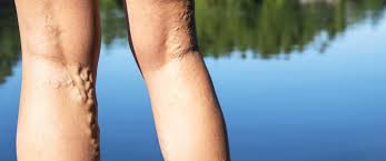 Skin care and health concept. The Hidden Dangers Of Varicose Veins Missouri Vein Specialists