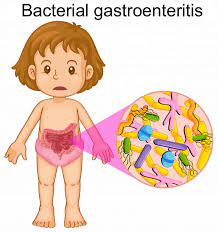 Clinical features of viral and bacterial gastroenteritis in hospitalized. Bacterial Gastroenteritis Causes Symptoms Diagnosis Treatment Prognosis
