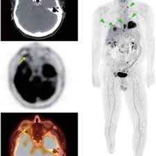Learn more about pet/ct scans at saint vincent hospital by talking with your doctor. Pdf Ophthalmologic Abnormalities On Fdg Pet Ct A Pictorial Essay