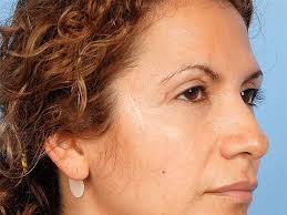 Botched surgeries prompt warning from plastic surgeons