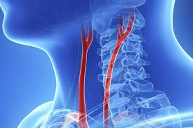 Arteria Entupida Carotida Arterias Coronarias Sintomas Diagnostico Puromd