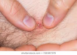 16,390,151 likes · 334,043 talking about this. Man With Longest Ingrown Hair On Face The Best Undercut Ponytail