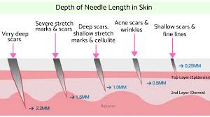 We did not find results for: How To Dermaroll Safely At Home Expert Guide To Dermarolling Microneedling Rejuviss Microneedling Dermatology Skin Care Dermapen Microneedling