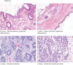These cells can be those of hair, teeth, brain or even eyes. Multi Region Exome Sequencing Of Ovarian Teratomas Reveals 2n Near Diploid Genomes Paucity Of Somatic Mutations And Extensive Allelic Imbalances Shared Across Mature Immature And Disseminated Components Biorxiv