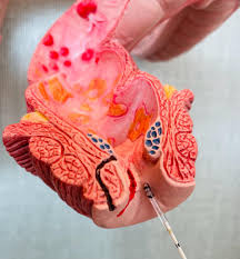 LASER para FISSURA ANAL CRÔNICA - Dr Fernando Bray