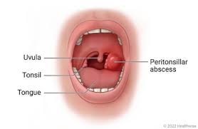 Image result for Peritonsillar Abscess