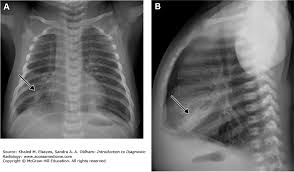 Pneumonia este o inflamație a țesutului pulmonar, de obicei cauzată de o infecție virală sau bacteriană. Pneumonia Pediatriavirtual Com