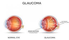 Glaucoma is a group of eye diseases characterized by damage to the optic nerve usually due to excessively high intraocular pressure (iop).this increased pressure within the eye, if untreated can lead to optic nerve damage resulting in progressive, permanent vision loss, starting with unnoticeable blind spots at the edges of the field of vision, progressing to tunnel vision, and then to blindness. Glaucoma Intraocular Pressure Condition