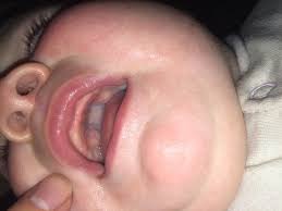 It produces creamy white and red patches or a blister on roof of mouth or that form on surfaces of the mouth. Thrush Or Not Can You Help Me To Look At Your Baby S Inside Mouth Top Roof Mumsnet