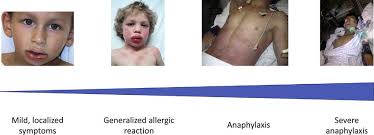 Give another injection after 5 to 15 minutes if the symptoms do not improve and a second. Spectrum Of Symptom Severity In Hypersensitivity Reactions And Download Scientific Diagram