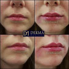 Keep reading for the 20 best lip plumpers, including glosses, balms, treatments, and more. 1ml Of Juvederm Volift To Plump The Lips And Lift The Corners Of The Mouth Www Dermamodels Co Uk Lips L Lip Fillers Exfoliating Lip Scrub Lip Fillers 1ml