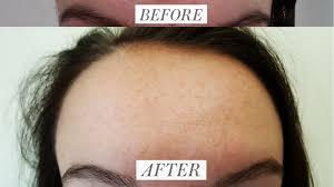 The majority of birth control pills use ethinyl estradiol as the estrogen ingredient. Spironolactone Clears Woman S Acne In 4 Months Before And After Photos Allure