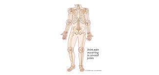 Ra mainly attacks the joints, usually many joints at once. Rheumatoid Arthritis Bcm