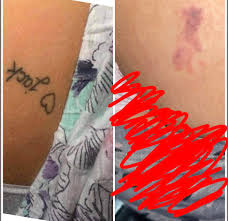 Inked up tattoo removal cream has been clinically proven to progressively fade away your tattoo. 5 Sessions With Picosure Ignore The Redness Tattooremoval