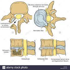 A layer of tissue that protects the spinal cord. Ligamentum Flavum Stockfotos Und Bilder Kaufen Alamy