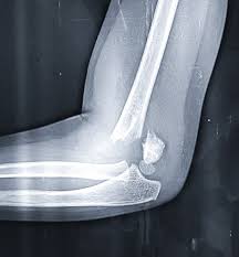 Image result for Elbow XRay
