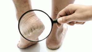 Cracked Heels Care: These home remedies will make cracked heels soft | Cracked  Heels Care: ಬಿರುಕು ಬಿಟ್ಟ ಹಿಮ್ಮಡಿಯನ್ನು ಸರಿಪಡಿಸಲು ಸುಲಭ ಮನೆ ಮದ್ದು Health News  in Kannada