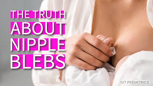 The Truth About Nipple Blebs - 127 Pediatrics