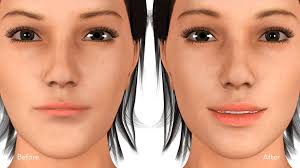 Dermal Fillers