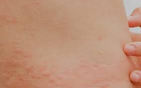 Find out some surprising reasons they can 5 causes of hives you wouldn't expect. Chronic Urticaria Hives Treatment London Hives Specialist Doctor Uk