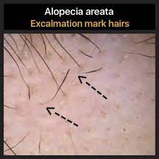 Check spelling or type a new query. Blog Of A Hair Loss Physician Exclamation Mark Hairs In The Autoimmune Hair