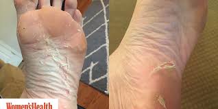 Dead skin can be removed by many creams with urea in them. Baby Foot Peel I Tried It And Here S What Happened Women S Health
